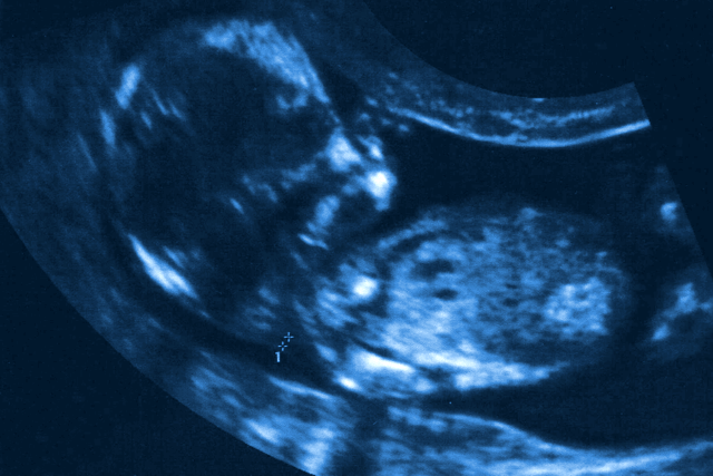 Узи плода 13 недель. УЗИ эмбриона 12 недель беременности ТВП. 12 Недель беременности воротниковое пространство на УЗИ. ТВП 10 недель беременности. УЗИ 10 недель беременности.
